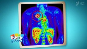 Позитронно-эмиссионная томография. Жить здорово! Фрагмент выпуска от 21.04.2015