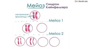 Синдром Клайнфельтера - механизм развития, причины, клинические проявления