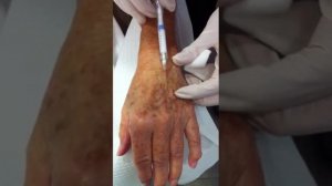 Radiesse hand filler rejuvenation San Diego