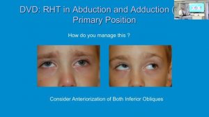 Vertical Strabismus -Advanced Surgical Techniques: Dr. Rudolph Wagner