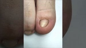 ШОК! Самый послушный клиент! Работа Подолога и  Коррекционной системы Унибрейс!