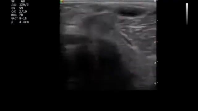 Медиальный мениск смотреть онлайн