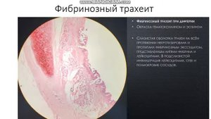 Фибринозный трахеит
