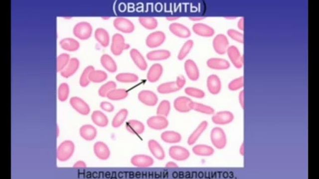 6. Патологические формы эритроцитов