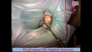 Изоляция 35- 37 зубов #Rubberdam для лечения 36 зуба.