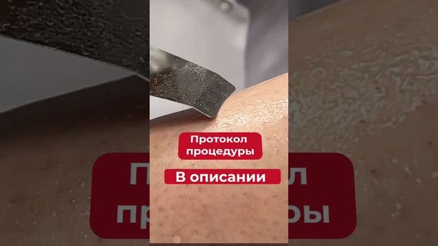 ? УЗ ПИЛИНГ от вросших волос.  Сохраняйте себе!