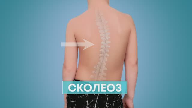 Сколиоз