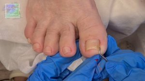 Подногтевая мозоль ? Гигиенический смарт педикюр ? Возрастной клиент