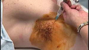 VTS 04 1 Проводниковая анестезия в аксиллярной области