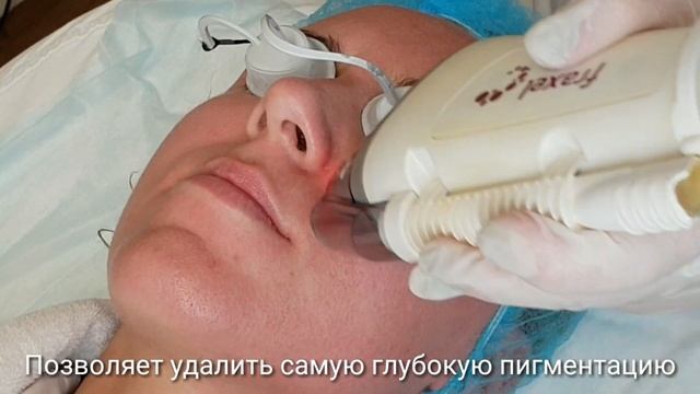 FRAXEL-омоложение лица в Центре косметологии ALTEOS Beauty