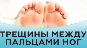 Трещины между пальцами ног.