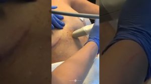 IMPROVE SURGICAL BREAST SCARS, BODY KELOIDS WITH FRAXEL + EXCEL V VASCULAR LASER | DR. JASON EMER