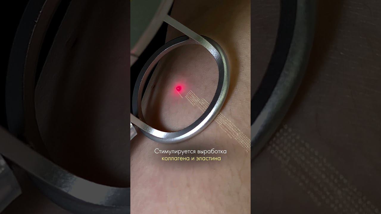 Удаление шрамов - лазерная СО2 шлифовка Dermaxel смотреть онлайн