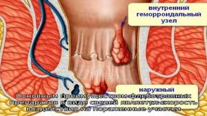 Венотонизирующие препараты при геморрое
