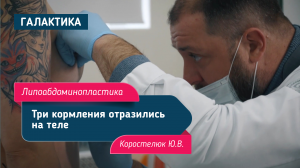 Липоабдоминопластика с ушиванием диастаза | Коростелюк Юрий Витальевич