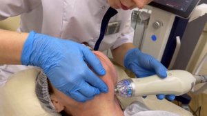 Микроигольчатый (игольчатый) RF-лифтинг