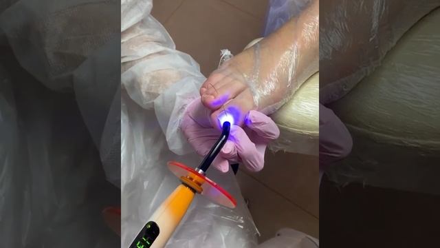 Медицинский педикюр с установкой титановой нити смотреть онлайн