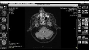 МРТ. Метастазы в головной мозг (информация для пациентов).