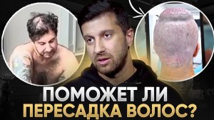 Амиран пересадил волосы. Что теперь? / Почему мужчины лысеют?