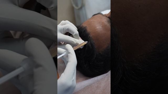 PRP for Hair Loss | PRP Hair Treatment #shorts