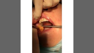 Удаление комков Биша в процессе