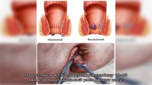 Склеротерапия геморроидального узла - цены в Москве