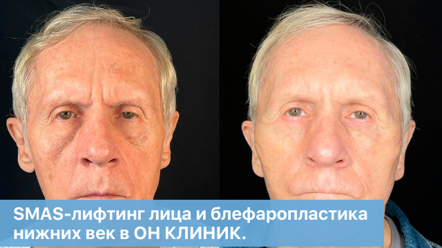SMAS-лифтинг лица и блефаропластика нижних век в ОН КЛИНИК. Комбинированная пластика лица.