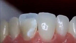 Как происходит реставрация зуба