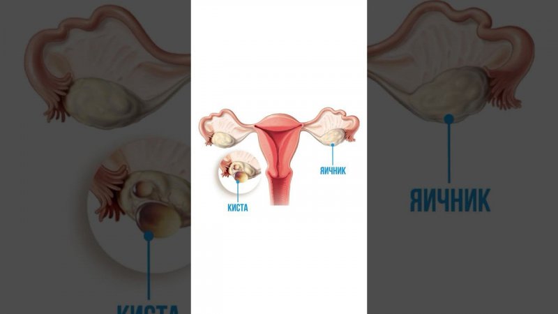 Симптомы кисты яичника. Кисты яичника у женщин. Лечение кисты яичника. Что нельзя делать при кисте