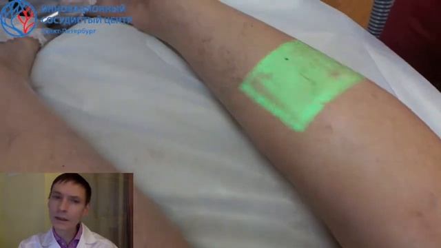 Склеротерапия косметических вен