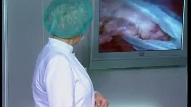Удаление рака поджелудочной железы