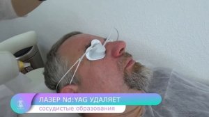 Удаление сосудов неодимовым лазером Nd:YAG ЦЛК Даная.