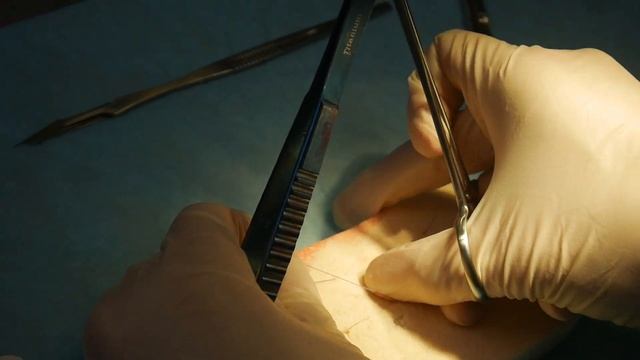 Внутрикожный шов по Холстеду (косметический шов) смотреть онлайн