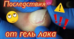 Последствия от гель лака⚠️❗️????