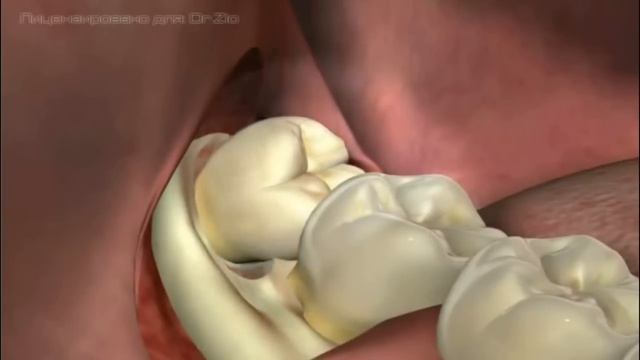 Удаление зуба мудрости смотреть онлайн