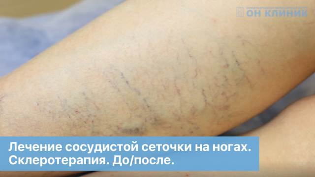 Лечение сосудистой сеточки на ногах. Склеротерапия. До/после.