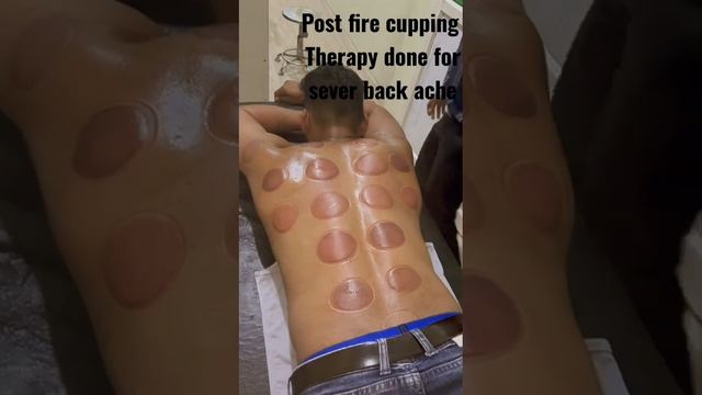 Fire cupping therapy for back ache