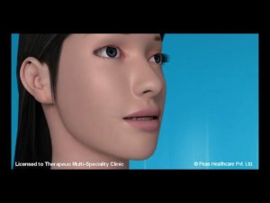 Герметизация фиссур