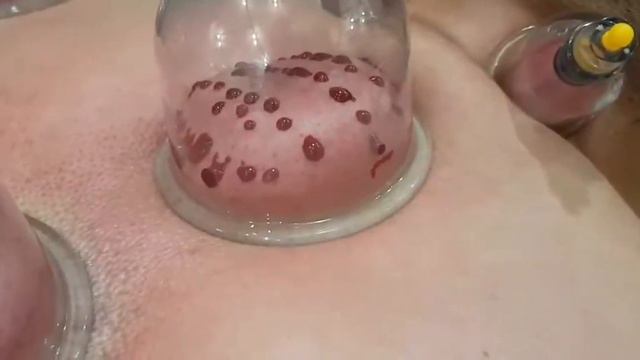 Хиджама как и зачем делают?) смотреть онлайн