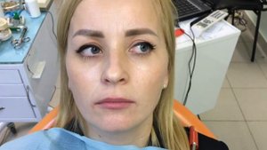Зубные коронки из металлокерамики. Реконструкция улыбки. Как выглядят зубы при разговоре.