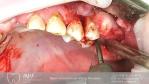 Открытый синус-лифтинг. Фиксация импланта сеткой.