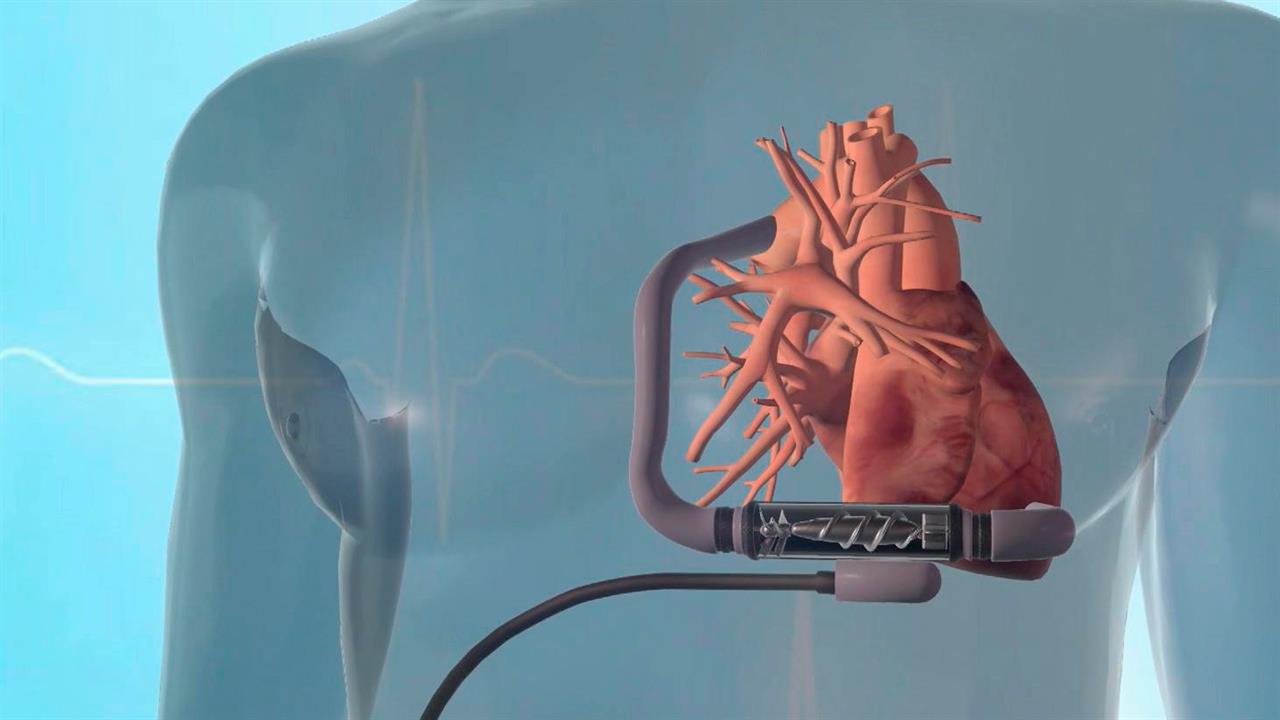 Сколько весит искусственный левый желудочек. Искусственное сердце. Искусственный левый желудочек сердца. Искусственный желудок. Имплантация искусственного сердца.