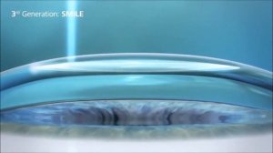 Фемто ЛАСИК (FemtoLASIK) и СМАЙЛ (ReLEx SMILE) - сравнение методов лазерной коррекции зрения
