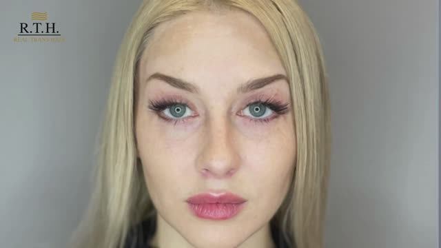 Хейлопластика и блефаропластика верхних и нижних век.