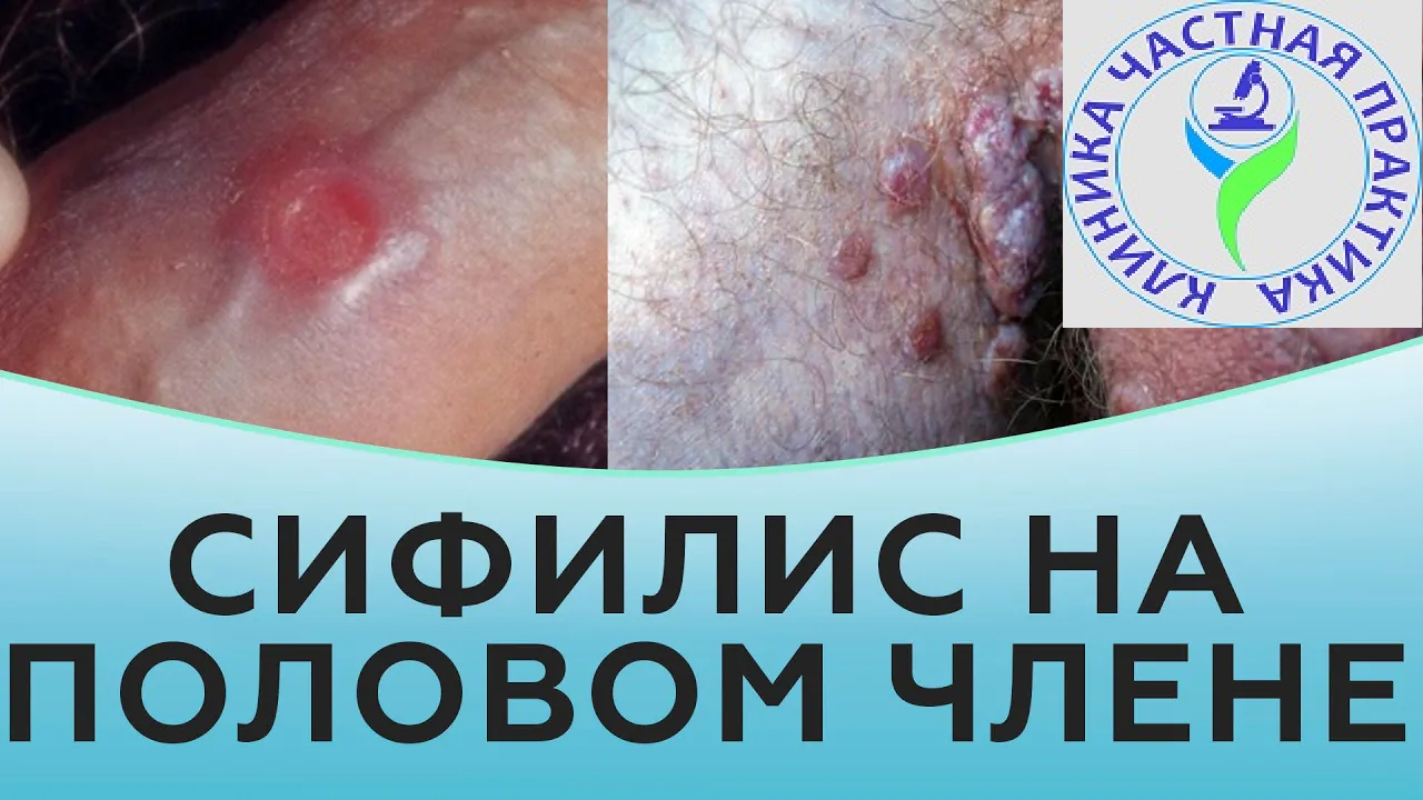 Сифилис на половом члене