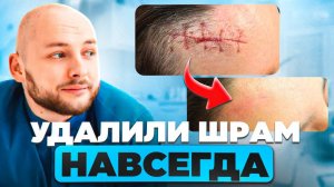 Как избавиться от ШРАМОВ навсегда? Удаляем рубцы без операции! | Косметология в Москве!