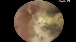 ДИАГНОСТИКА ЛЕЧЕНИЕ  #ГРИБКОВОГО #ОТИТА #ОТОМИКОЗ