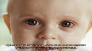 Почему у ребенка круги под глазами: возможные причины? Что делать, если у ребенка появились темные.