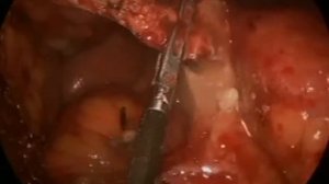 Laparoscopy in Mesenteric Occlusion 1