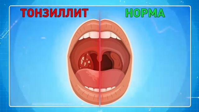 Здоровое горло и тонзиллит. Отличия